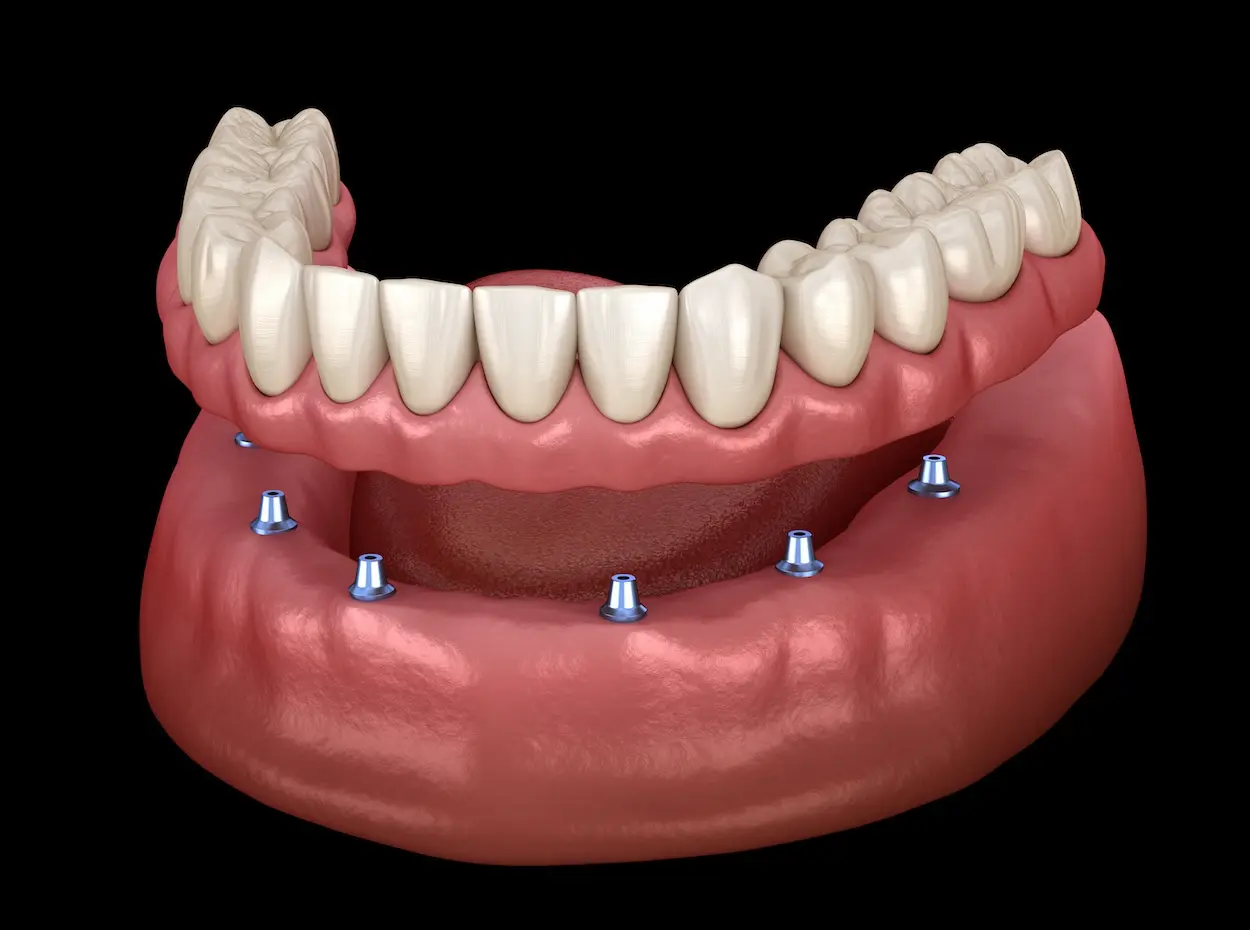 Dentures & Partial Dentures