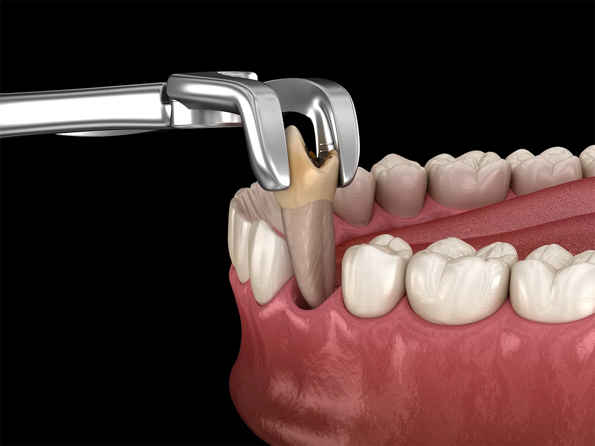 Tooth Extractions